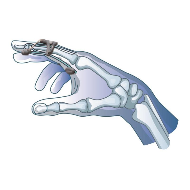 Extenční ortéza prstu PSL 180—Velikost S