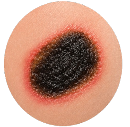 Nekrotická rána